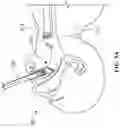 Fig. 13 - Intubation system, method, and device