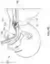 Fig. 15 - Intubation system, method, and device