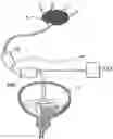 Fig. 01 - IMPLANTABLE DRAINAGE DEVICE