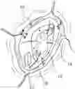 Fig. 01 - UNIVERSAL POWER SUPPLY FOR A FUNCTIONAL CRANIAL IMPLANT