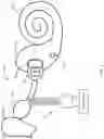 Fig. 04 - Combination hearing aid and cochlear implant system
