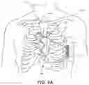 Fig. 04 - DEVICE AND METHOD FOR ATRIAL TACHYARRHYTHMIA DETECTION