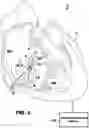 Fig. 07 - Evaluation and adjustment of left bundle branch (LBB) pacing therapy