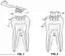 Fig. 02 - TEETH CLEANING AND REMINERALIZING TOOTHPASTES