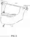 Fig. 03 - Dynamic mouth opening device