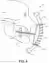 Fig. 05 - Dynamic mouth opening device