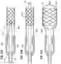 Fig. 18 - Methods of safely expanding prosthetic heart valves