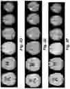 Fig. 07 - Method for detecting radiological progression in cancer surveillance