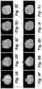 Fig. 09 - Method for detecting radiological progression in cancer surveillance