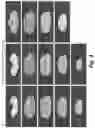 Fig. 10 - Method for detecting radiological progression in cancer surveillance
