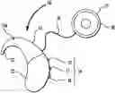 Fig. 01 - Hearing prosthesis system having interchangeable housings