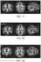 Fig. 04 - Nutritional composition and infant formula for promoting myelination of the brain