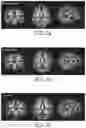 Fig. 04 - Nutritional composition and infant formula for promoting de novo myelination