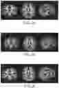 Fig. 05 - Nutritional composition and infant formula for promoting de novo myelination