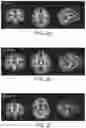 Fig. 06 - Nutritional composition and infant formula for promoting de novo myelination