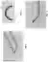 Fig. 07 - METHOD AND APPARATUS FOR MANIPULATING THE SIDE WALL OF A BODY LUMEN OR BODY CAVITY SO AS TO PROVIDE INCREASED VISUALIZATION OF THE SAME AND/OR INCREASED ACCESS TO THE SAME, AND/OR FOR STABILIZING INSTRUMENTS RELATIVE TO THE SAME