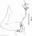 Fig. 70 - METHOD AND APPARATUS FOR MANIPULATING THE SIDE WALL OF A BODY LUMEN OR BODY CAVITY SO AS TO PROVIDE INCREASED VISUALIZATION OF THE SAME AND/OR INCREASED ACCESS TO THE SAME, AND/OR FOR STABILIZING INSTRUMENTS RELATIVE TO THE SAME
