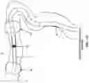 Fig. 83 - METHOD AND APPARATUS FOR MANIPULATING THE SIDE WALL OF A BODY LUMEN OR BODY CAVITY SO AS TO PROVIDE INCREASED VISUALIZATION OF THE SAME AND/OR INCREASED ACCESS TO THE SAME, AND/OR FOR STABILIZING INSTRUMENTS RELATIVE TO THE SAME