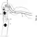 Fig. 84 - METHOD AND APPARATUS FOR MANIPULATING THE SIDE WALL OF A BODY LUMEN OR BODY CAVITY SO AS TO PROVIDE INCREASED VISUALIZATION OF THE SAME AND/OR INCREASED ACCESS TO THE SAME, AND/OR FOR STABILIZING INSTRUMENTS RELATIVE TO THE SAME