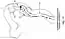 Fig. 85 - METHOD AND APPARATUS FOR MANIPULATING THE SIDE WALL OF A BODY LUMEN OR BODY CAVITY SO AS TO PROVIDE INCREASED VISUALIZATION OF THE SAME AND/OR INCREASED ACCESS TO THE SAME, AND/OR FOR STABILIZING INSTRUMENTS RELATIVE TO THE SAME