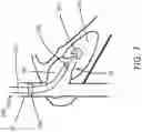 Fig. 08 - Direct endoluminal-and/or endovascular-illumination systems and methods of use thereof