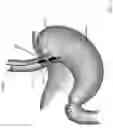 Fig. 08 - SYSTEMS, DEVICES AND METHODS FOR DETERMINING LARYNGOPHARYNGEAL PRESSURE AND/OR LOWER OESOPHAGEAL SPHINCTER PRESSURE