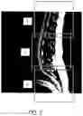 Fig. 03 - MR spectroscopy system and method for diagnosing painful and non-painful intervertebral discs