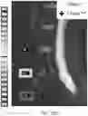 Fig. 42 - MR spectroscopy system and method for diagnosing painful and non-painful intervertebral discs