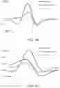 Fig. 31 - CATHETER SYSTEMS AND RELATED METHODS FOR MAPPING, MINIMIZING, AND TREATING CARDIAC FIBRILLATION