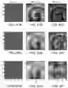 Fig. 43 - CATHETER SYSTEMS AND RELATED METHODS FOR MAPPING, MINIMIZING, AND TREATING CARDIAC FIBRILLATION