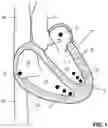 Fig. 02 - Cardiac Device, Method and Computer Program Product