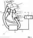 Fig. 05 - Cardiac Device, Method and Computer Program Product