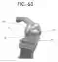 Fig. 22 - ORTHOPEDIC JOINT DISTRACTION DEVICE