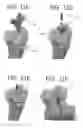 Fig. 33 - ORTHOPEDIC JOINT DISTRACTION DEVICE