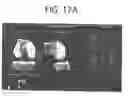 Fig. 41 - ORTHOPEDIC JOINT DISTRACTION DEVICE