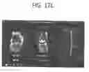 Fig. 43 - ORTHOPEDIC JOINT DISTRACTION DEVICE