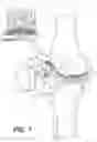 Fig. 02 - Tilting surgical tensor to support at least one bone cut