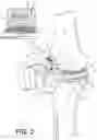 Fig. 03 - Tilting surgical tensor to support at least one bone cut