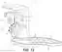 Fig. 07 - Tilting surgical tensor to support at least one bone cut