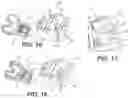 Fig. 10 - Tilting surgical tensor to support at least one bone cut
