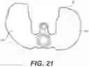 Fig. 13 - Tilting surgical tensor to support at least one bone cut