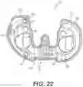 Fig. 14 - Tilting surgical tensor to support at least one bone cut