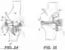 Fig. 23 - Tilting surgical tensor to support at least one bone cut