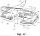 Fig. 38 - Tilting surgical tensor to support at least one bone cut