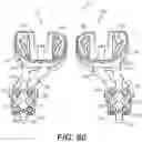 Fig. 41 - Tilting surgical tensor to support at least one bone cut