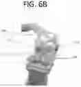 Fig. 22 - Method of planning an arthroplasty procedure