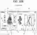 Fig. 30 - Method of planning an arthroplasty procedure