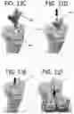 Fig. 33 - Method of planning an arthroplasty procedure