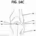 Fig. 38 - Method of planning an arthroplasty procedure