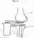 Fig. 39 - Method of planning an arthroplasty procedure